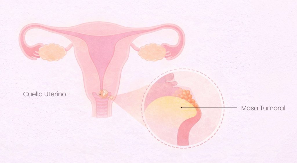 cuello uterino anatomia cancer cuello uterino vph ilustracion